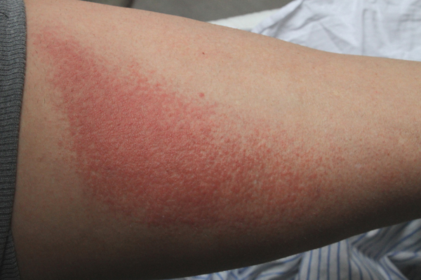 streptokocker på huden bilder streptokocker på huden bilder
